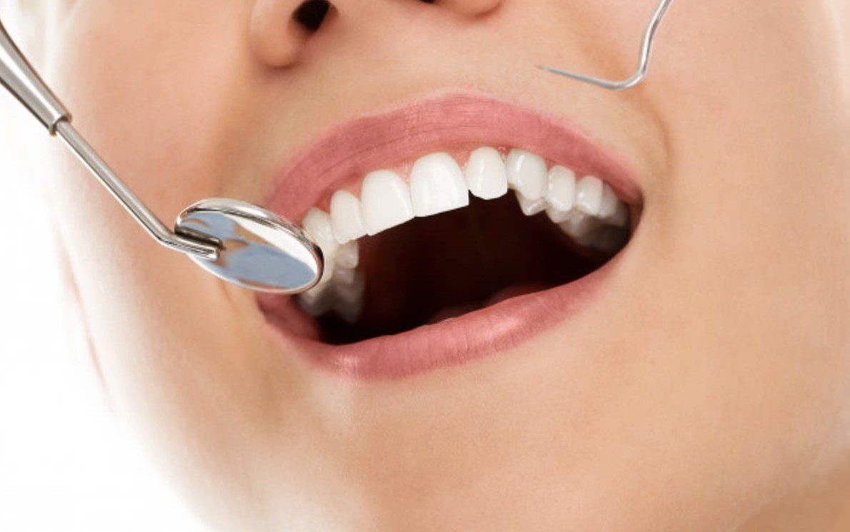 Les techniques des dentistes pour avoir un beau sourire